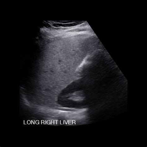 Pediatric Hepatic Steatosis | Pediatric Radiology Reference Article | Pediatric Imaging ...