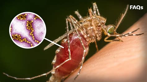 Leading symptoms of West Nile Virus, explained