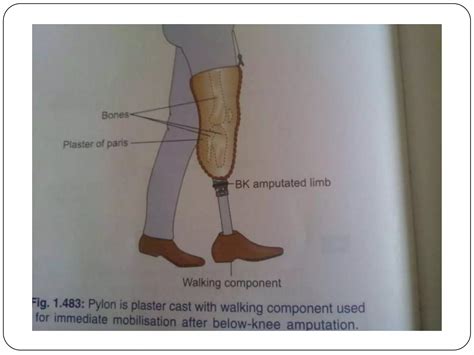 Icd 10 For Below The Knee Amputation | Detroit Chinatown