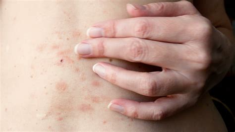 Is Eczema Contagious? The Facts, Explained | Weather.com