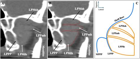 Morphological Spectrum of the Lateral Pterygoid Muscle: Radioanatomical ...