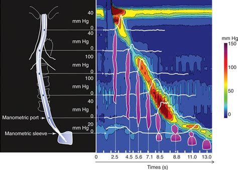 High-Resolution Esophageal Manometry: Techniques and Use in the ...