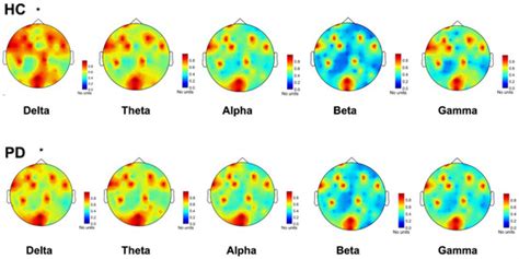 Quantitative High Density EEG Brain Connectivity Evaluation in ...