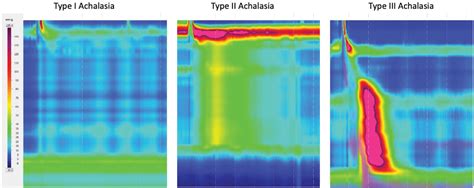 Esophageal Achalasia Wikipedia