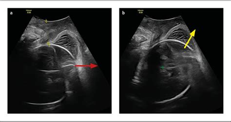 Intrapartaler Ultraschall - Gynäkologie & Geburtshilfe - Universimed ...