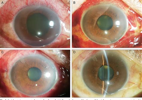 Subconjunctival Injection 的图像结果