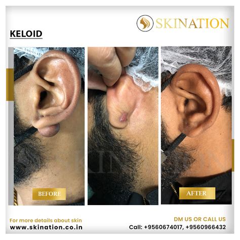 Keloid Treatment in Faridabad & Chhattarpur