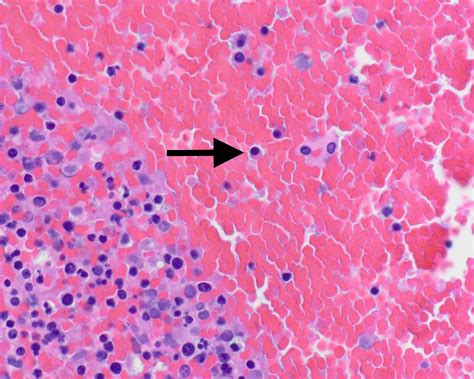 Pathology Outlines - Intrauterine fetal demise