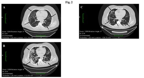 A Novel Tx for Severe COVID-19 Pneumonia | MedPage Today