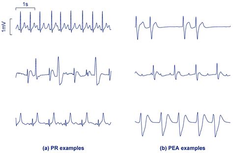 Pulseless Electrical Activity Ecg