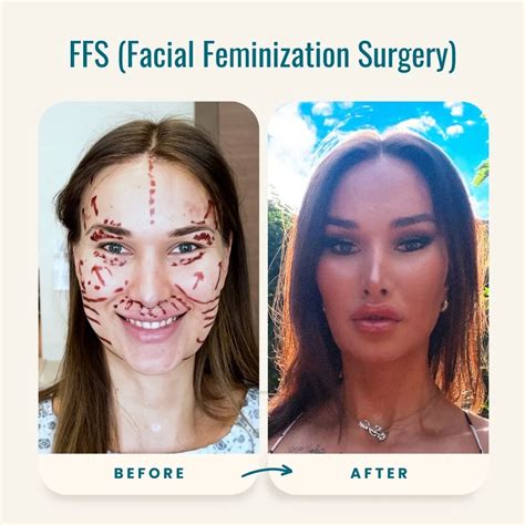 Facial Feminization Surgery – Precision That Respects Identity | iMed Medical