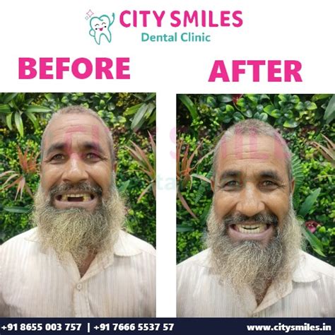Transform Your Smile: Before and After at City Smiles Dental Clinic ...