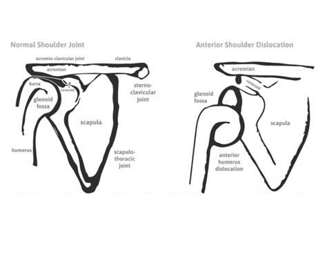 Shoulder Dislocation Contortion 的图像结果