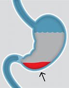 Image result for Gastroparesis