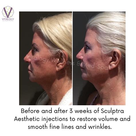 Sculptra Injections for face and body | 2 year solution You Will Love