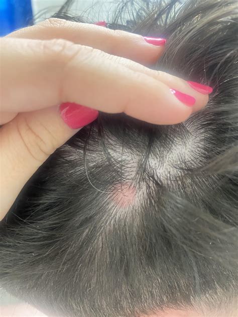 What are these light pink spots on scalp. Have had them for many years. At least 6 years : r ...