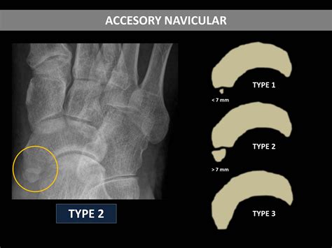 Navicular Anatomy
