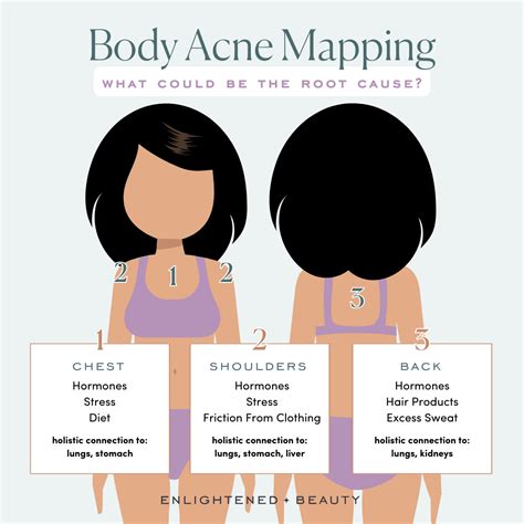 Decoding The Body’s Acne Map: Understanding The Clues Your Skin Reveals - "Belmont City Map ...