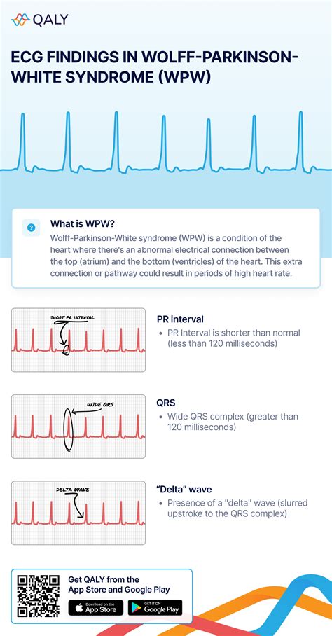 Wpw Syndrome Delta Wave