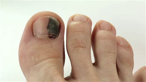 Subungual hematoma. Bruise under the nail of big toe. Injury to the ...