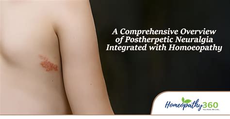 A Comprehensive Overview of Post Herpetic Neuralgia Integrated with ...