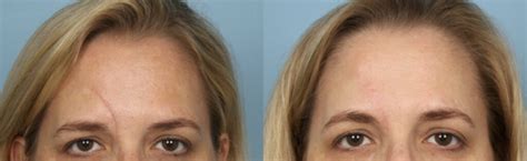 Scar Revision Procedure 的图像结果