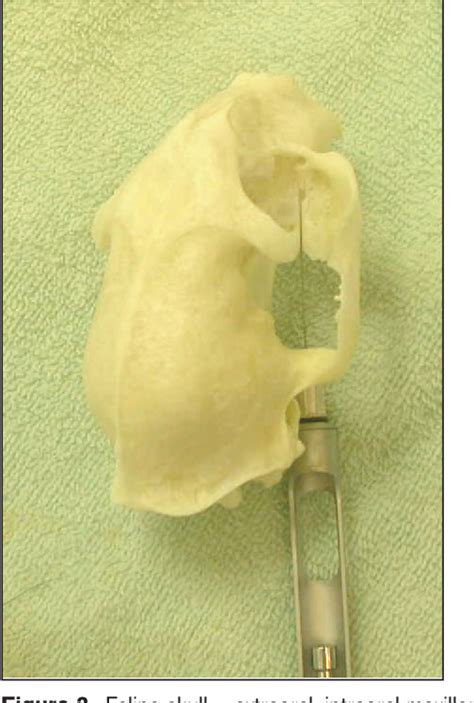 Image result for Single Tooth Root Nerve Block