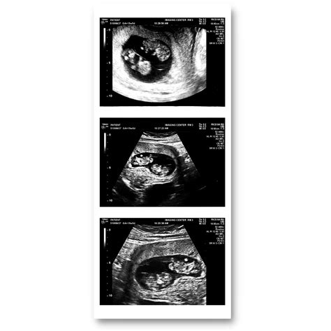 9 Weeks Pregnant Ultrasound Twins