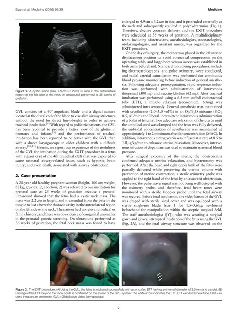 SOLUTION: Use of the glidescope video laryngoscope for intubation ...