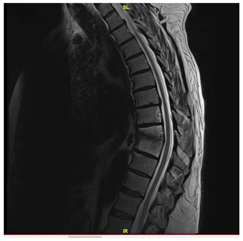 Neisseria sicca Vertebral Osteomyelitis: A Case Report and Literature ...
