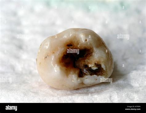 Image result for Wisdom Tooth Decayed