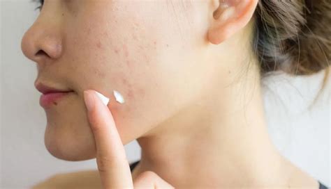 4 DIY Ways To Get Rid of Chicken Pox Scars - lifeberrys.com