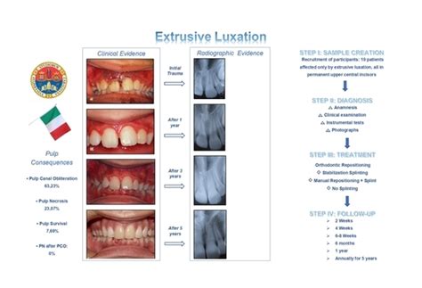 Extrusive Luxation Injuries in Young Patients: A Retrospective Study ...