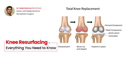 Knee Resurfacing: Everything You Need to Know