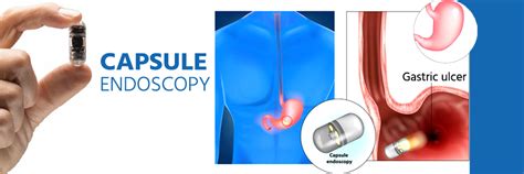Capsule Endoscopy Cost in India - Get Price Estimate
