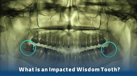 Wisdom Teeth Infection Top 10 Wisdom Tooth Infection Symptoms | KWC
