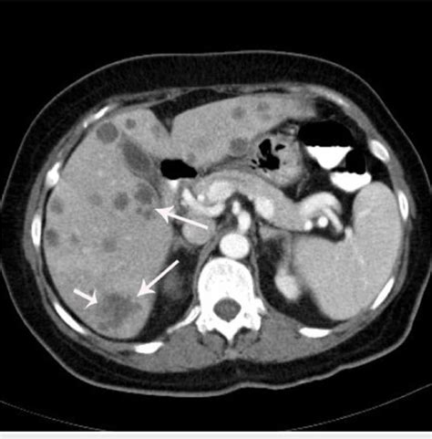 Figure 3 from Multiple Pyogenic Liver Abscesses Mimicking Metastatic ...