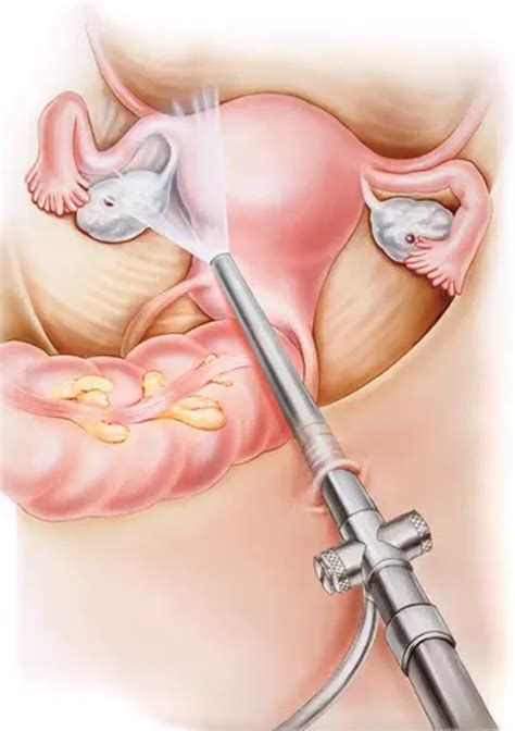 Image result for Fallopian Tube Surgery