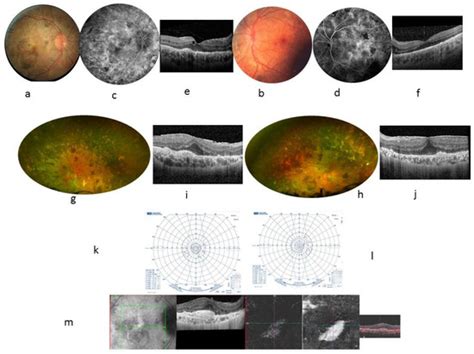 Casitas B-lineage lymphoma Gene Mutation Ocular Phenotype
