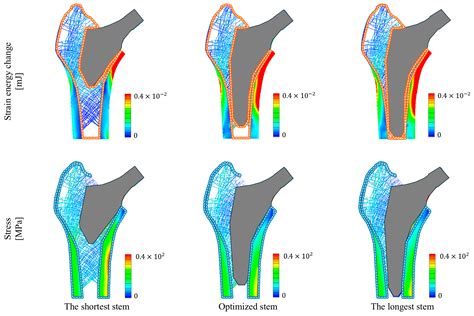 Personalized Stem Length Optimization in Hip Replacement: A Microscopic ...