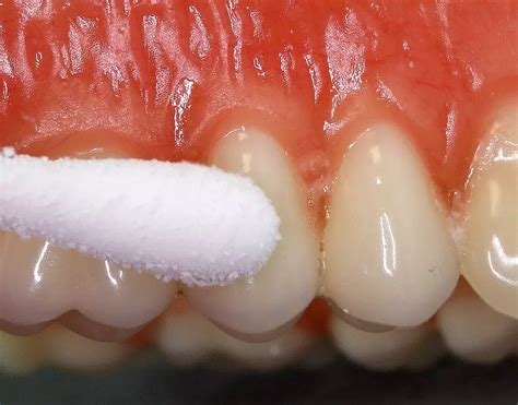 Electric pulp test effective for assessing pulpal sensitivity in ...