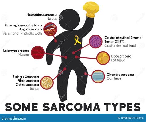 Infographic Showing Some Sarcoma Types And Principal Affected Tissues, Vector Illustration ...