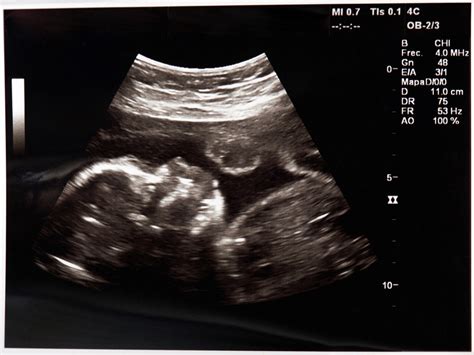 Fetal ultrasound images - 4 months | BabyCenter