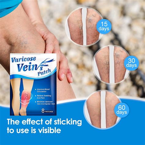Buy Varicose Veins Patch Relief Flebitis Angiitis Remedy வலி நிவாரணப் ...