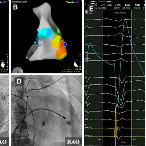 Image result for PVC Localization Chart