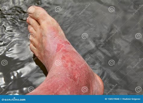 Foot Swollen After Sunburn