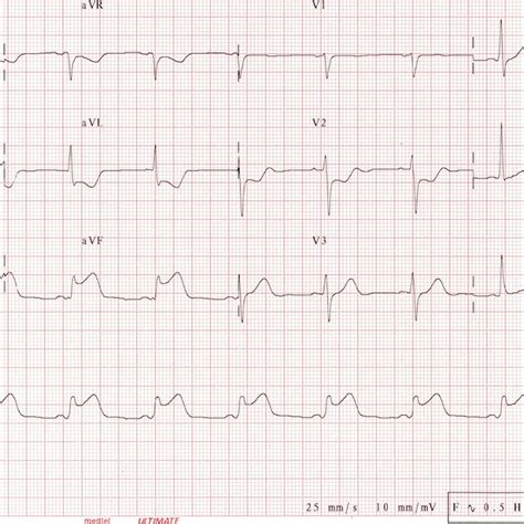 Electrocardiogram Training