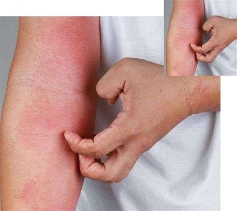 Eczema Treatment in Delhi, Saket at SkinQure