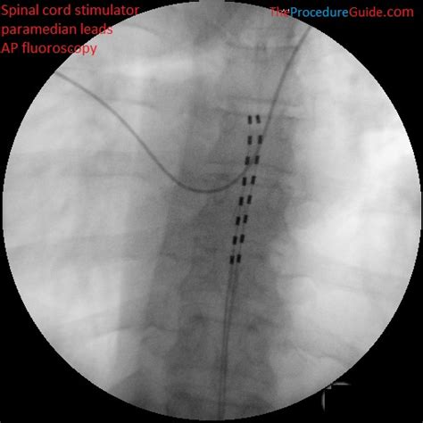 Image result for Fluoro Spinal Injection