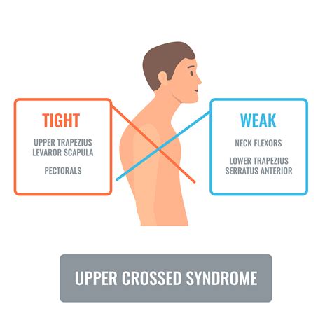 Table 6 11 Upper Crossed Syndrome Summary Common Posture Strains: